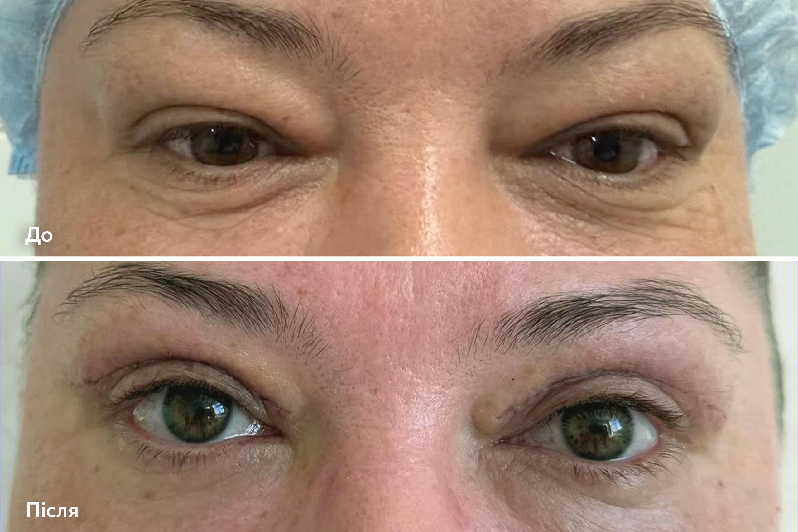 Блефаропластика