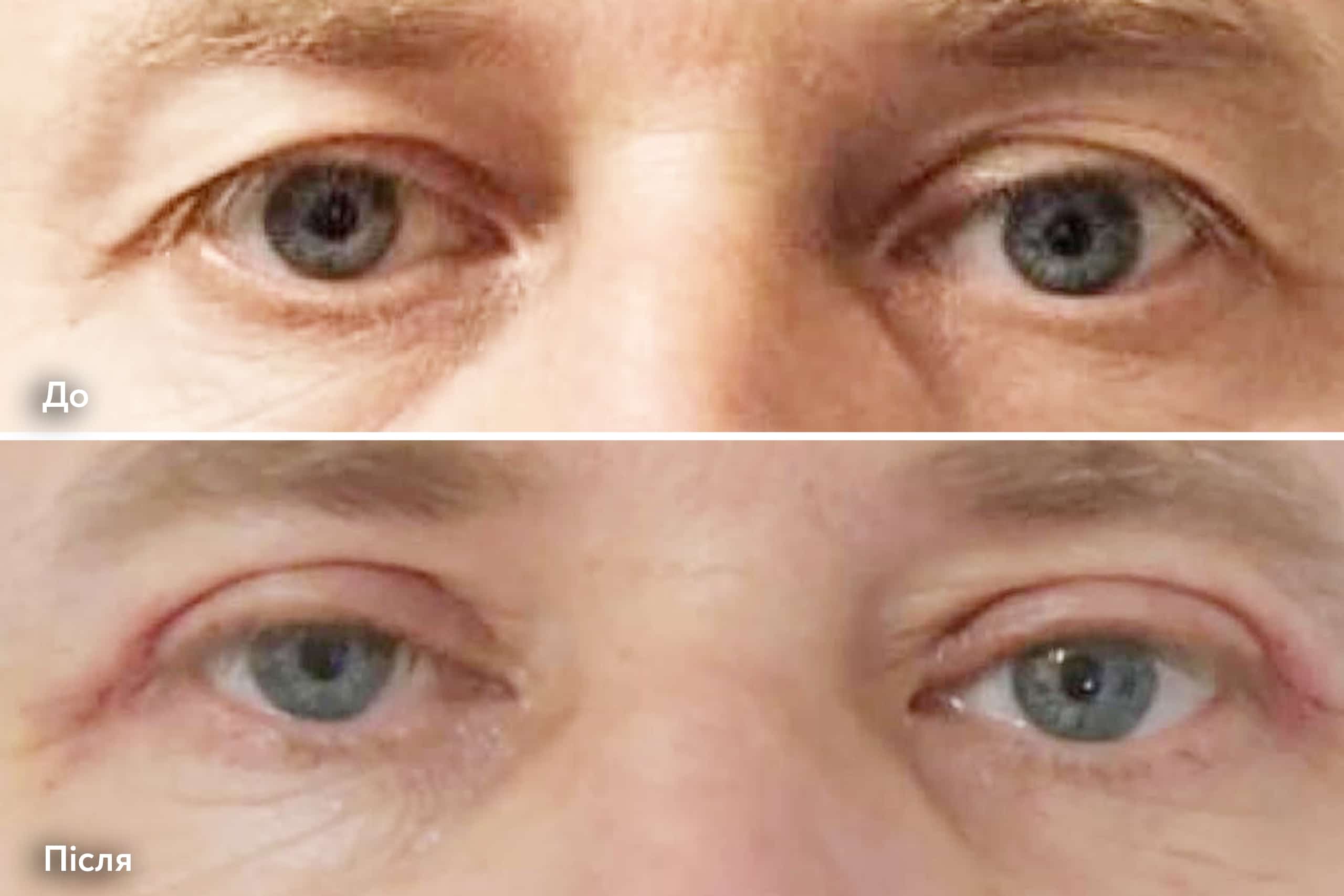 Блефаропластика для мужчинн