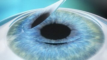 лазерная коррекция зрения методом 5D-Eye Lasik