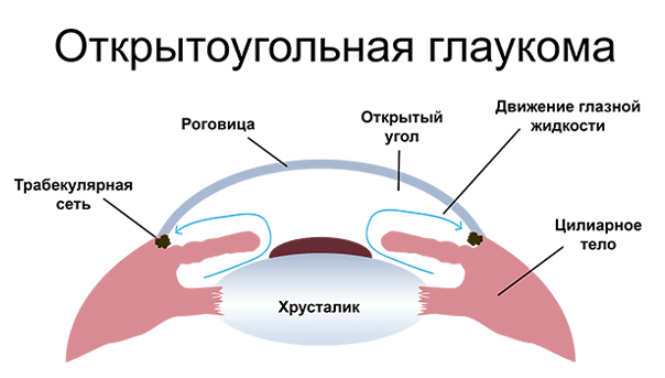 Открытоугольная глаукома. Первичная открытоугольная глаукома 3а. Открытоугольная глаукома симптомы. Первичная открытоугольная 2 а глаукома. Первичная открытоугольная глаукома симптомы.