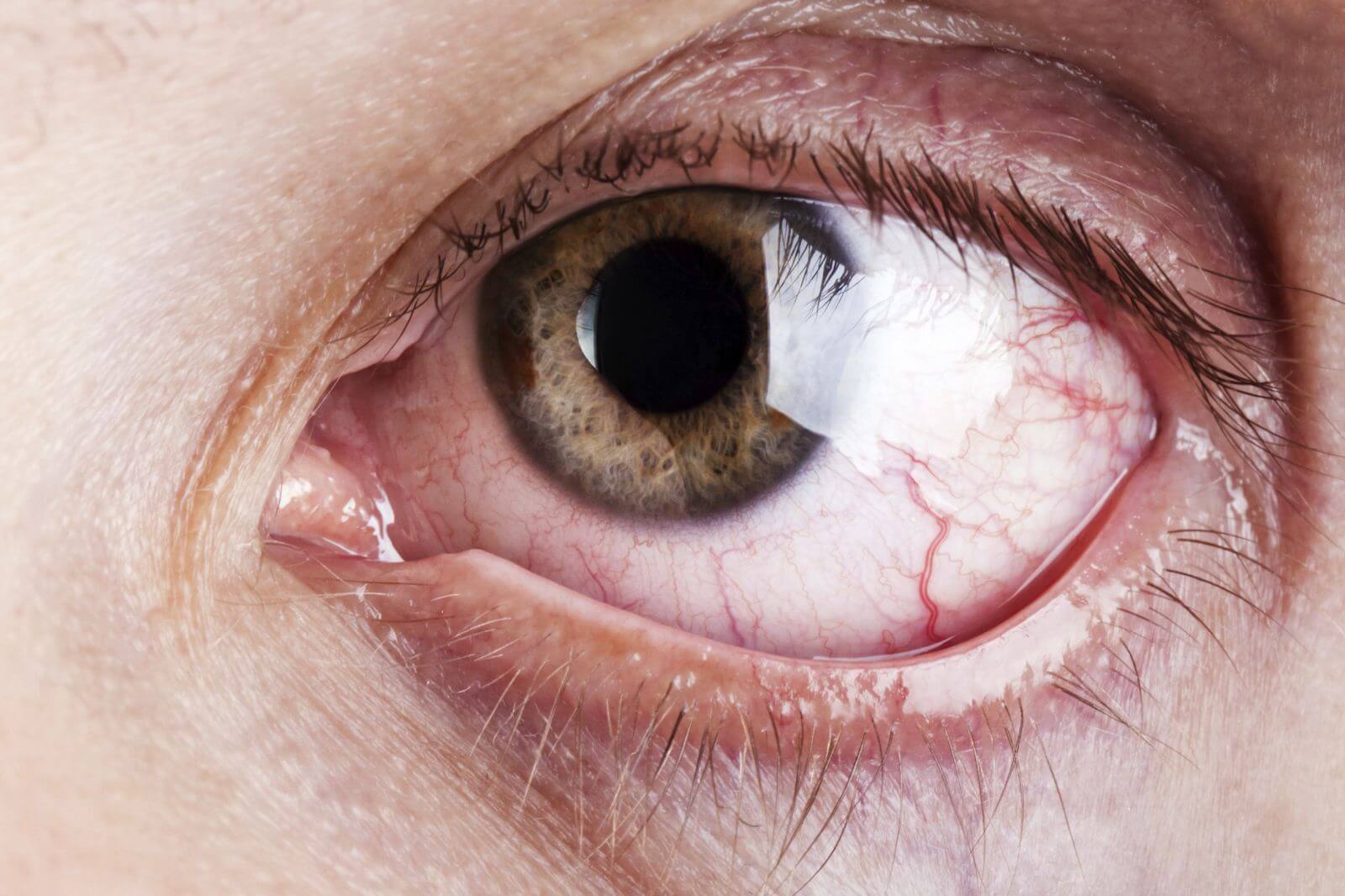 Что такое глаукома? Виды, причины, симптомы, диагностика и лечение глаукомы